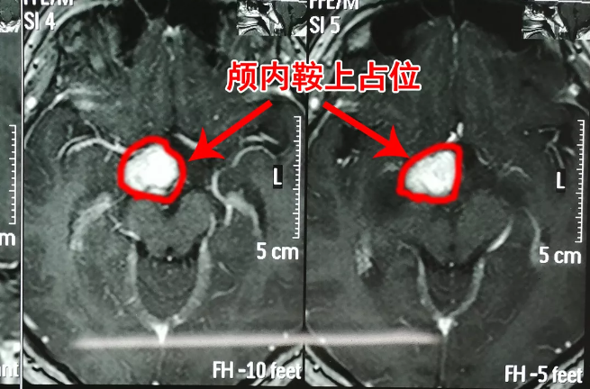 胸部變大的男孩，竟是因?yàn)槟X中長了腫瘤