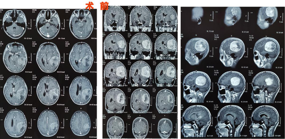 3歲有斗雞眼，父母忽視，13歲發(fā)現(xiàn)巨大腦腫瘤，這些癥狀需警惕!