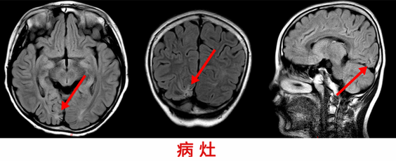 10歲男童癲癇4年 精準(zhǔn)手術(shù)切癲癇灶“除根”-病灶