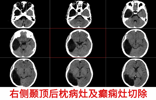 10歲男童癲癇4年 精準(zhǔn)手術(shù)切癲癇灶“除根”