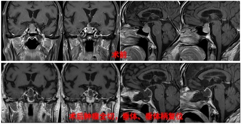  高齡是腦外科手術(shù)禁忌？三博腦科醫(yī)院86歲腦腫瘤患者術(shù)后3天順利出院