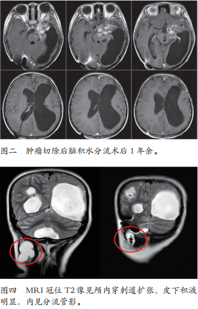 V-P分流后并發(fā)癥2例