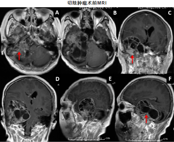 專訪首都醫(yī)科大學(xué)三博腦科醫(yī)院-張明山教授-側(cè)顱底腫瘤手術(shù)入路選擇探討