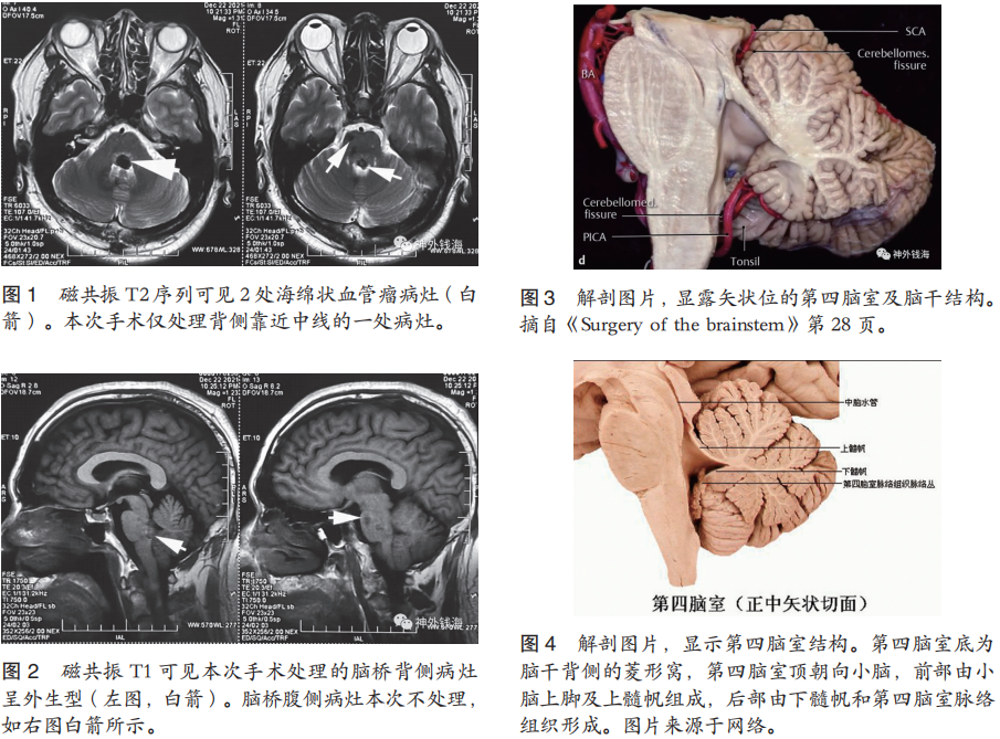 一例腦干海綿狀血管瘤的手術(shù)陷阱