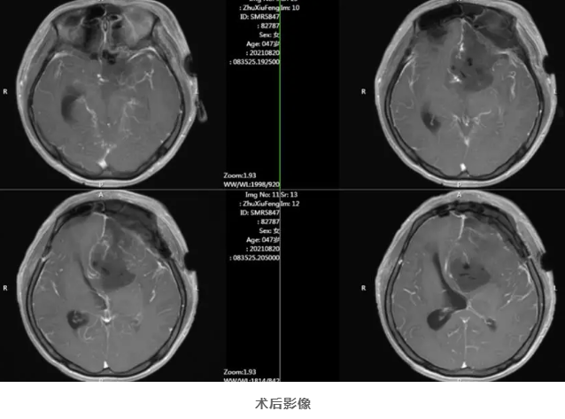 潛伏十余年 中年女子巨大腦膜瘤被成功切除